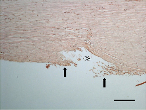 Figure 2 Goniotomy with the KDB GLIDE resulted in excision of a strip of trabecular meshwork over the canal of Schlemm (CS) with minimal (0 to 50 µm) residual leaflets (arrows) and no damage to adjacent structures. H&E stained sections, scale bar = 200 µm.