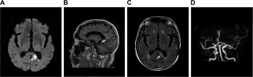 Figure 1 Case 1 magnetic resonance imaging and MRA of brain.