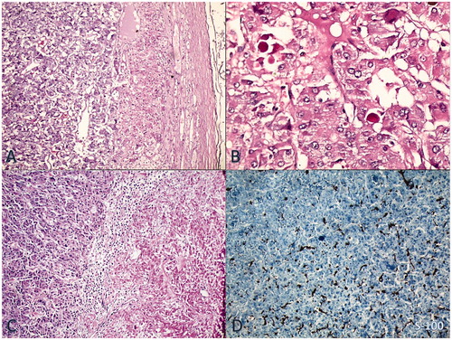 Figure 2. (A) Notice on the left side of the figure typical nested pattern of the tumor resembling normal adrenal medulla (H&E × 50). (B) High power view shows tumor cells with intracytoplasmic eosinophilic globules (H&E × 200). (C) Right-sided coagulative necrosis of the tumor (H&E × 50). (D) Sustentacular cells immunostained for S100 protein at the periphery of the tumor nests (IHC × 50).