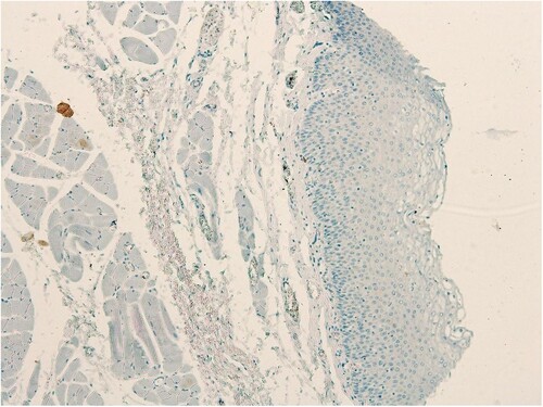 Figure 1. Absent SALL4 expression in normal laryngeal epithelium