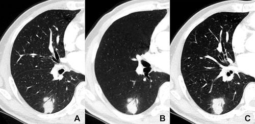 Figure 2 A patient with diabetes and pulmonary cryptococcosis. (A) axial and (B) minimum intensity projection images show a solid nodule located in the right lower lobe. There are multiple natural bronchi in it. (C) axial CT image shows that the nodule is surrounded by annular and ill-defined ground glass opacity (halo sign).