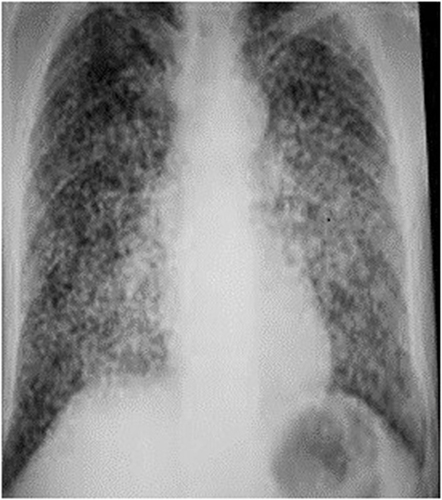 Figure 3 Chest X-ray showing numerous small nodular opacities scattered throughout the lungs.
