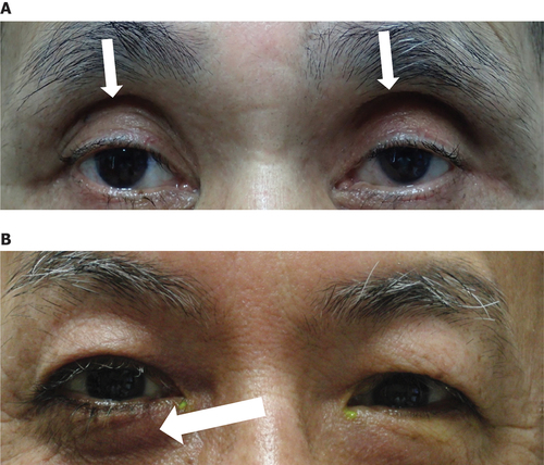 Figure 1. Commonly reported PAPS signs and symptoms. Notable signs of PAPS include DUES and FLEB. (A) A patient who had undergone PGA treatment. DUES (arrows) was observed. (B) A patient who underwent PGA treatment in the right eye, and trabeculectomy in the left eye. FLEB (arrow) was observed. Images courtesy of Prof. Makoto Aihara.
