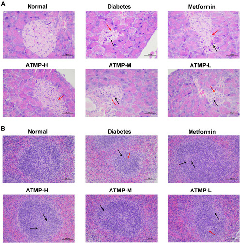 Figure 4 Histopathological findings of the protective effects of ATMP against pancreas and spleens damage in diabetes. Representative images of pancreas and spleen tissues stained with hematoxylin and eosin dye for the normal, diabetes, metformin, ATMP-H, ATMP-M and ATMP-L groups. (A) Pancreases (magnification 400 ×). Cell swelling and cytoplasm loose vacuoles (red arrows), cell nucleus pyknosis (black arrows) (B) Spleens (magnification 200 ×). Germinal centers (black arrows), cells were necrotic or apoptotic, with pyknotic or fragmented nuclei (red arrows).