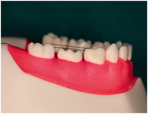 Figure 1. Master tooth preparation.