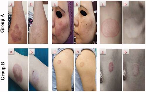 Figure 6. Representative patients of tinea corporis receiving F7 (group A) and Miconaz® cream (group B), showing clinical evidence of efficacy of group A. (a, b) Patients before and after treatment, respectively.