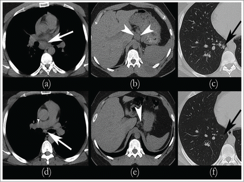 Figure 2. Sequential CT scans showing response to therapy. Metastatic Renal Medullary Carcinoma with Complete Remission of Disease post chemotherapy and it remained the same while on maintenance: CT scan prior to the initiation of chemotherapy revealed significant lymphadenopathy consistent with metastatic disease in the mediastinum (A), gastrohepatic ligament (B), and in the right lung (C). After Cycle 4 of chemotherapy, CT imaging revealed complete remission of mediastinal (D), gastrohepatic ligament (E), and pulmonary (F) nodules.