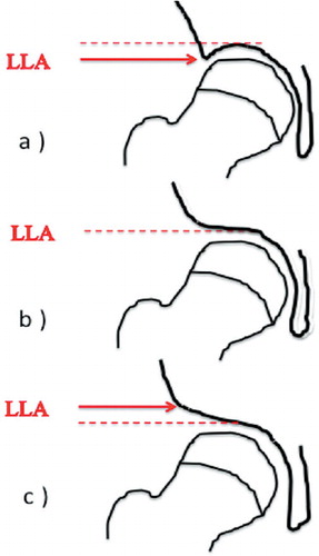 Figure 2. Schematic illustration of the lateral acetabular inclination. The lateral lip of the acetabulum (LLA) is (a) below the weight-bearing dome of the acetabulum (dotted line), (b) horizontal, and (c) above the weight-bearing dome of the acetabulum.