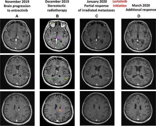 Figure 1 MRI evolution of brain metastases after fractionated stereotactic brain radiotherapy (A–C) and lorlatinib treatment (D). Three out of the five lesion treated with stereotactic radiotherapy are depicted (B), in the left thalamus (upper panel), left parietal lobe (middle panel) and left lateral ventricle (lower panel). In the upper panel, a contra-lateral sub-centimetric parietal lesion, visible in the first three MRI (A–C), is no more detectable after lorlatinib initiation (D). MRI sequences are 3D MP-RAGE (magnetization prepared – rapid gradient echo) after administration of chelate of gadolinium.