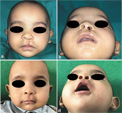 Figure 8. A case of Fisher’s group; 4-month-old male, with left-sided unilateral incomplete cleft lip. (a and b) Preoperative frontal and submental views and (c and d) 3 months’ postoperative frontal and submental views