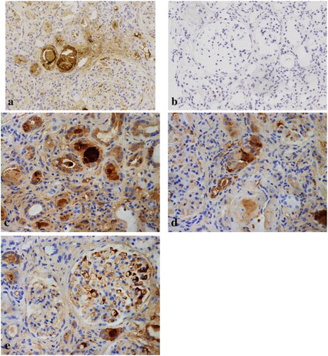 Figure 4. On immunohistochemistry, kappa light chain-restricted expression (a: κ, 200 × original magnification) while lambda was negative (b: λ, 200 × original magnification) in proximal tubular epithelial cells (c: κ, 400 × original magnification), histiocytes (d: κ, 400 × original magnification), and podocytes (e: κ, 400 × original magnification).