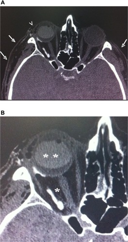 Figure 2 Orbital CT scan.