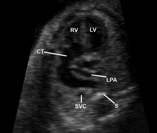 Figure 1.  A single large vessel arises from the left and right ventricles. A thin vessel, subsequently confirmed to correspond to the left pulmonary artery, originates from the left side of this arterial trunk. RV, right ventricle; LV, left ventricle; CT, common arterial trunk; LPA, left pulmonary artery; SVC, superior vena cava; S, fetal spine.