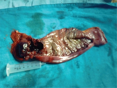 Figure 1 Resected specimen of ileum showing polypoidal mass of size 3.5 × 2.5 × 2 cm intraluminally adjoining the stricture having hemorrhagic surface area and rest of the mucosa shows multiple superficial ulcers of 0.5 cm size.