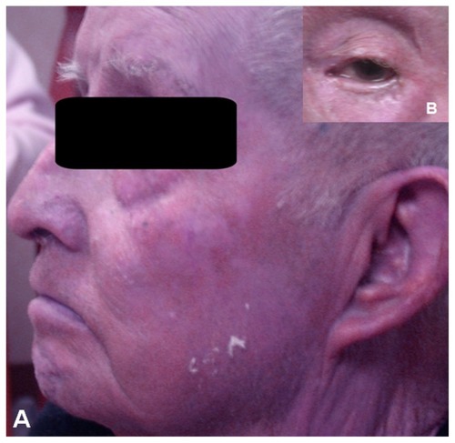 Figure 1 Clinical picture of the patient’s face showing the gray-bluish hue of the skin of the face, scalp, and neck (A), including the periocular region, conjunctiva, and sclera (B).