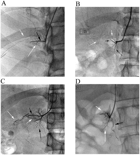 Figure 6. The signature veins of the right adrenal gland. (A) A 27-year-old male patient’s brush vein (long white arrow) almost vertically drained into the central vein (black arrow). The renal capsular vein (short white arrow) communicated with the brush vein expanded laterally. (B) In the ‘spider type’ of a 46-year-old male patient, the central vein (short black arrow) and the uvula vein (long black arrow) can be distinguished, but the brush vein was not shown. It could be seen that the renal capsular veins (white arrows), like soft vines, drained into nearly the outlet of the central vein. The overall shape of these renal capsular veins was similar to the spider’s foot. (C) A 42-year-old male patient’s venographic image showed relatively complete adrenal veins: the central vein (short black arrow), the uvula vein and its branch veins (long black arrow), the lateral limb vein (short white arrow), and the renal capsular vein (long white arrow) communicated with the distal end of the central vein. (D) The ‘solid triangle type’ of a 57-year-old female patient included the solid upper triangle venous enhancement area (short white arrow) and the lower uvula vein (long white arrow). It was common that the renal capsular vein (long black arrow) connected with the renal vein.