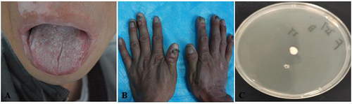 Figure 4 Patient No.4 (A) Image of oral mucosal of the patient (B) Image of fingers of the patient (C) Results of incubation on SDA at 37°C from the oral mucosal of the patient.