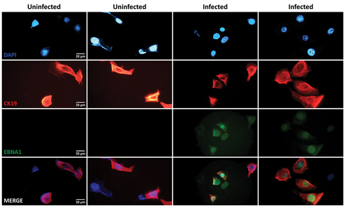 Figure 3.  Dual immunofluorescent staining of CK19 (junctional epithelial cell marker; red fluorescence) and EBNA1 (EBV infection marker; green fluorescence) in uninfected and infected cell cultures generated from a single patient. After the completion of 1-day infection, JECs were cultured for an additional 3 days. Micrographs from duplicate experiments are shown. Cell nuclei are stained with DAPI. Magnification, 630×. Positive ENBA1 signal indicates possible EBV infection of JECs.