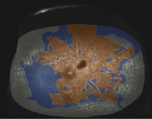Figure 3 Widefield FA 3 months later, following additional targeted retinal photocoagulation.