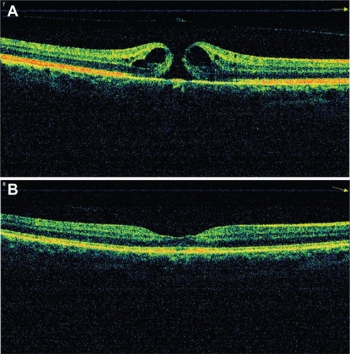 Figure 3 A representative patient with stage 4 macular hole. Preoperative (A) and postoperative 3 month (B) optical coherence tomography images.