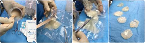 Figure 2 Steps for intraoperative custom preparation of polymethyl methacrylate implants. (A) Mixing the PMMA acrylic resin powder with the liquid component (from the set) in a sterile ampoule in a well-ventilated atmosphere. (B) Open the peelable pouch and start emptying the whole contents. (C) Enclose into the sterile foil pouch, ie, plastic sleeves. (D) transfer the plastic sleeves to the sterile surgical area, and when the dough-like material does not adhere to the surgical gloves of the surgeon, the PMMA resin is ready for manipulation. Apply the resin to the osseous defect and remove any excess resin.