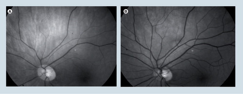 Figure 4. Simultaneously recorded images of the human retinal vessels using a single flash.(A) Oxygen-sensitive image at 600 nm. (B) Oxygen-insensitive image at 570 nm. The arteries are lighter in (A) because oxyhemoglobin light absorption is relatively low.