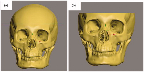 Figure 5. Cut the top part. a) Select the “Slice” tool; Move the cursor to a suitable place; b) Selecting “Remove the top” to delete the skull cap.