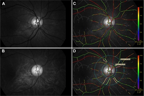 Figure 1 Fundus images at two different wavelengths of light obtained by Oxymap T1 and the oxygen saturation map analyzed by Oxymap Analyzer.