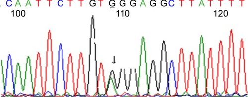 Figure 5 A heterozygous (c.1235 G>A) mutation was identified in exon 4 of the EXT1 gene.
