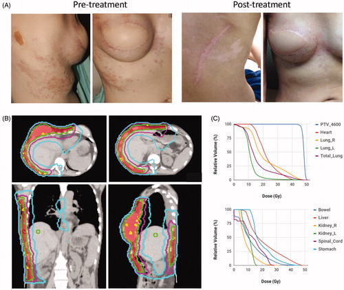 Figure 4. Pre- and post-treatment images and radiation plan for a patient with extensive ER + PR + Her2+ breast cancer recurrence treated with hyperthermia and IMRT. (A) Pretreatment (left) and 2 months post-treatment (right) images of a patient with recurrent Her2+ breast cancer. (B) Radiation dose distributions on axial (top), coronal (bottom left) and sagittal (bottom right) images for the patient. The PTV is shaded in red and treated to 46 Gy. Isodose lines are shown: 50 Gy (yellow), 46 Gy (green), 36 Gy (pink), 20 Gy (blue). (C) Dose volume histograms (DVH) for the PTV, heart, lung, small bowel, liver, kidney, spinal cord and stomach are shown.
