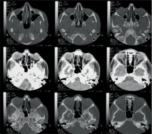 Figure 3 CT scan orbit showing no signs of bone involvement, with normal sinuses.