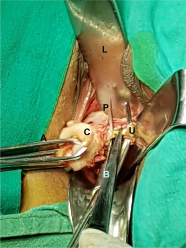 Figure 5 Skeletonized uterine artery (U) of the left side was coagulated using bipolar forceps (B) between prongs of right angle forceps (P).