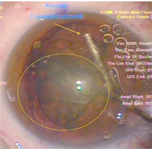 Figure 4 Insertion of the irrigation cannula just under the capsulorhexis at the 6 o’clock position (12 o’clock in this surgeon’s view) – another novel step in the procedure. The surge of the hydrodissection at this point has “pushed” the separated cataract quadrant (yellow oval) into the pupillary plane. Note again, at this stage of the procedure, the multiple bubbles relocating anteriorly, just under the cornea. These bubbles represent gas produced by the lens fragmentation stage of the femtosecond procedure and have been trapped within the posterior part of the cataract until this stage.