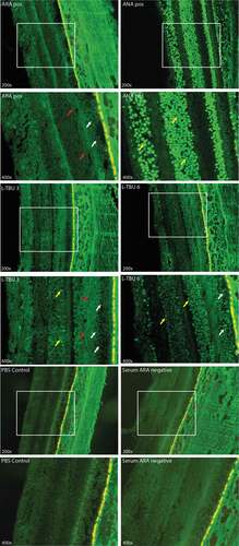 Figure 5. Representative indirect immunofluorescence microscopy images for antiretinal antibodies (ARA) on primate retinal tissue incubated with serum from two different L-TBU patients and negative and positive controls (ARA positive serum control first column, first and second row, anti-nuclear antibodies (ANA) positive serum control second column, first and second row, patient no. 3 first column, third and fourth row; patient no. 6 second column, third and fourth row; PBS control first column fifth and sixth row; ARA and ANA negative serum second column, fifth and sixth row). Images were visualized at 200x magnification (first, third and fifth row) with the indicated square shown at 400x magnification (second, fourth and sixth row). The arrows depict positive staining for antiretinal antibodies (ARA) of the photoreceptor layer (white arrows), outer limiting membrane (red arrows), and nuclear antigens (yellow arrows)