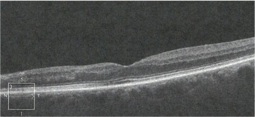 Figure 2 OCT scan of retina in cross-section showing loss of RPE and deep retinal structures nasal to the fovea 14 weeks after the occlusion.