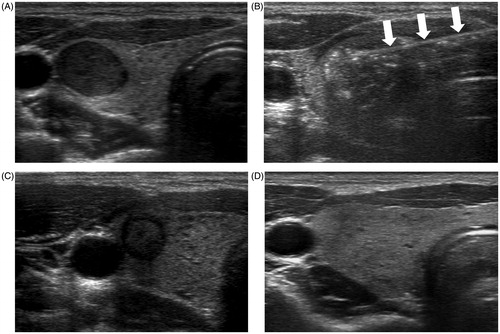 Figure 2. A 31-year-old woman with a right thyroid nodule proven to be a follicular neoplasm on core needle biopsy. (A) A well-defined hypoechoic solid thyroid nodule on the transverse US image. (B) An echogenic totally ablated thyroid nodule with a RF electrode (arrows) on the transverse US image. (C) One month after RFA, the nodule had decreased and there was no undertreated area. (D) Two years after RFA, the nodule had disappeared.