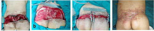 Figure 6 The wound image of typical case 2. (a) preoperation, (b) VSD was placed a week later, (c) intraoperation, (d) postoperative day 17. The length, width and depth of the wound are 45.4 cm, 13.3 cm and 2 cm, respectively. The area is 603.82 cm2.