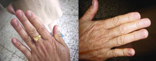Fig. 1.  Photograph displaying the fingernails of the 48-year-old female patient. Bajiaolian poisoning had occurred six years earlier. This patient had cut her thumb nails once a month prior to the intoxication, but had not cut her nails following the intoxication.