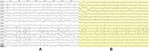 Figure 5 Case 2 - NREM 3 y.o. (A) vs 5 y.o. (B) (bipolar montage).