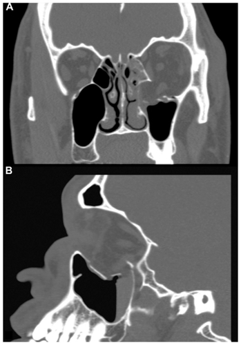 Figure 1 Coronal A) and sagittal B) computed tomography images showing a large fracture of the left orbital floor with herniation of a large volume of orbital fat and a vertically elongated inferior rectus muscle extending to the fracture site.