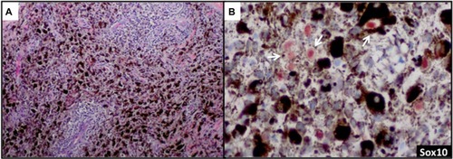Figure 3 Sox10 identifies rare tumor cells in heavily regressed areas of melanoma.