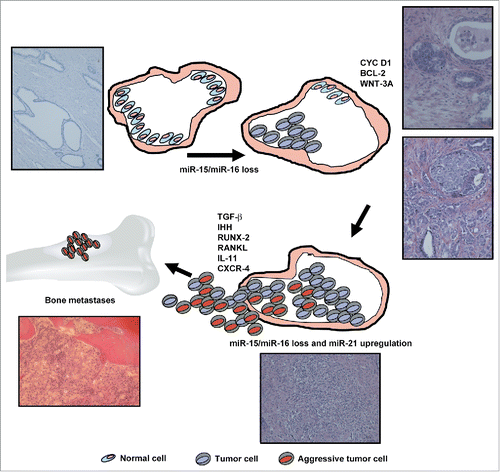 Figure 1. Molecular mechanisms whereby alterations in miR-15, miR-16, and miR-21 result in aberrant TGF-β signaling. Hematoxylin and Eosin staining of patient tissues is reported. BCL-2, B-cell lymphoma; CXCR-4, C-X-C chemokine receptor type 4; CYC D1, cyclin D1; IHH, Indian hedgehog; IL-11, Interleukin 11; RUNX-2, Runt-related transcription factor 2; RANKL, Receptor activator of nuclear factor kappa-B ligand; TGF-β, Transforming growth factor β; WNT-3A, Wingless-Type MMTV Integration Site Family, Member 3A.