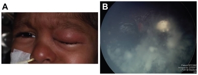 Figure 2 (A) Diffuse periocular edema following intra-arterial infusion of melphalan, which resolved without sequelae. (B) Fundus photograph showing progression of vitreous seeding despite two sessions of intra-arterial chemotherapy.