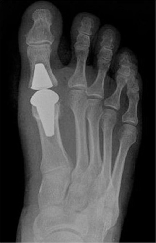 Figure 4 Postoperative anteroposterior views of the metatarsals of a patient in the total joint replacement group.
