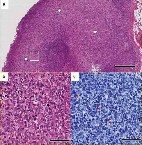 Figure 2. Pathological findings in the left axillary lymph node. (a) Localized, focal lesions (white stars) that obscure the lymph node structure. [hematoxylin & eosin (H&E)]. Scale bar: 500 μm. (b) Numerous nuclear debris (red arrows) and some enlarged lymphocytes (black arrows). High-magnification view of the area in the white rectangle in (a). Scale bar: 50 μm. (c) Granulocytes are not evident. Nuclear debris (red arrows) that appear to have been phagocytosed by histiocytes. High-magnification view of the area in the white rectangle in (a). [Giemsa stain.] Scale bar: 50 μm.