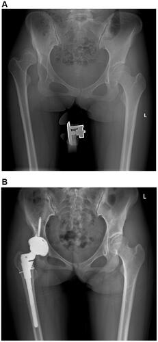 Figure 4 X-ray of a 24-year-old woman undergoing THA without subtrochanteric osteotomy. (A) Pre-operative X-ray. (B) Post-operative X-ray.