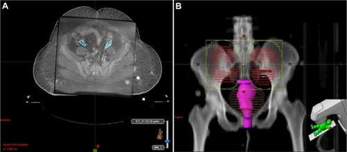 Figure 8 (A) MR imaging fusion with CT simulation data to delineate ovaries and planning target volume and (B) Beam’s eye view.