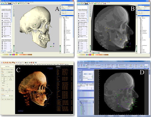 Figure 2. Image showing (a) 3D generated skull representation, and (b) generated cephalograms measurements in Maxilim software, (c) cephalometric measurements in In vivo and (d) Romexis software packages.