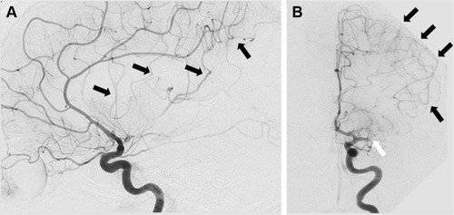 Figure 2 Initial left internal carotid angiogram (lateral [A], and anteroposterior [B] views) showing proximal occlusion of the left middle cerebral artery (white arrow), lack of perfusion in the respective territory, and collateral flow from the left anterior cerebral artery through leptomeningeal anastomoses (black arrows).