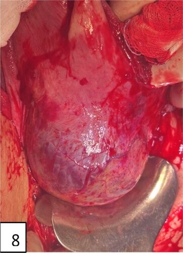 Figure 8. Distraction, placental bulge, and neovascularization of lower uterine segment anteriorly.